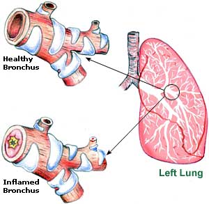 bronchitis-picture